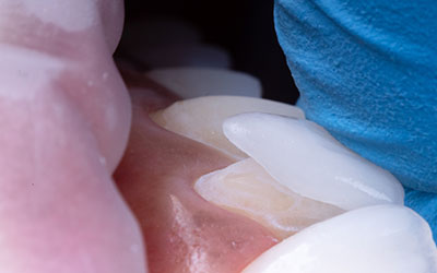 短期間で確実に歯を白くできる　ラミネートべニア