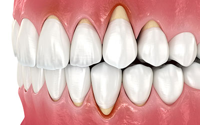 下がった歯ぐきのボリュームを取り戻す　歯ぐき形成