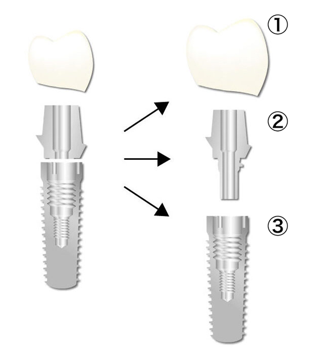 基本のインプラント手術費用