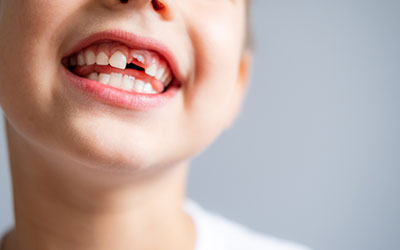 生えたばかりの永久歯は歯質が弱くて柔らかい