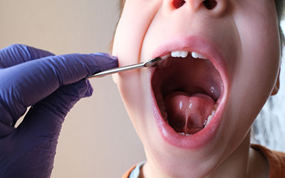 舌小帯短縮症の手術