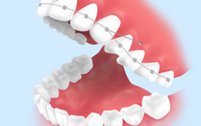 効果的に歯を動かすインプラント矯正