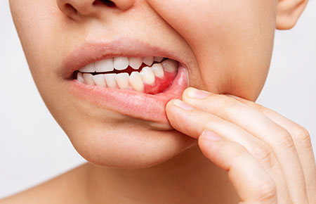 歯周病は早期発見・早期治療が大切