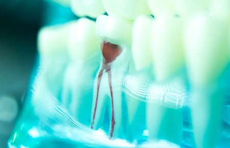 精密な治療で、できる限り歯を残す―根管治療（歯内療法）―