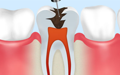 虫歯や薬剤の除去
