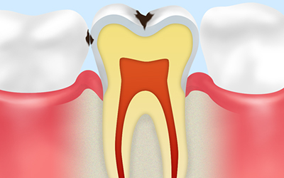エナメル質の虫歯