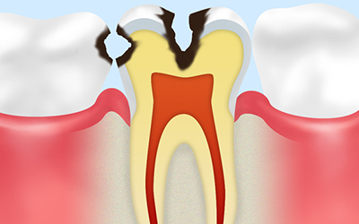 象牙質の虫歯