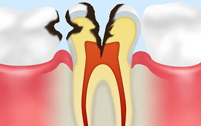 神経まで達した虫歯