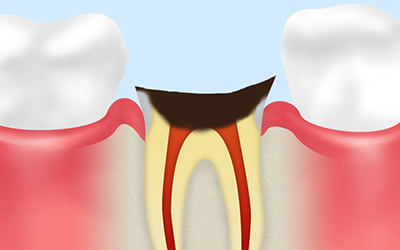 歯根まで達した虫歯