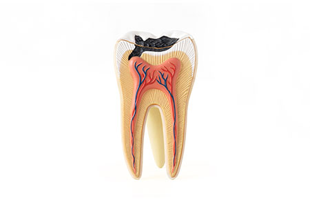 神経まで進行した虫歯でも「できるだけ歯を残す」　～根管治療・歯内療法～