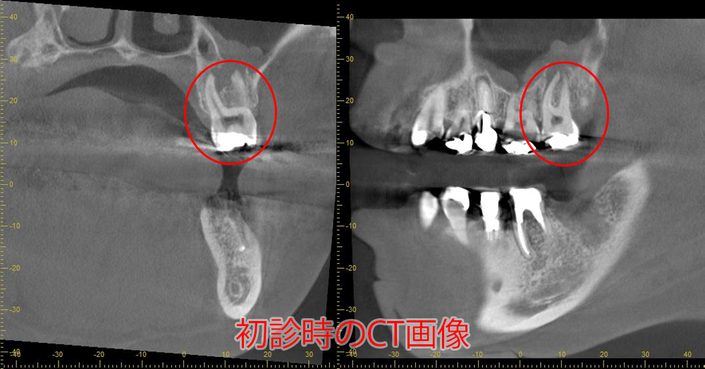 初診時と術後6か月のCT画像の比較