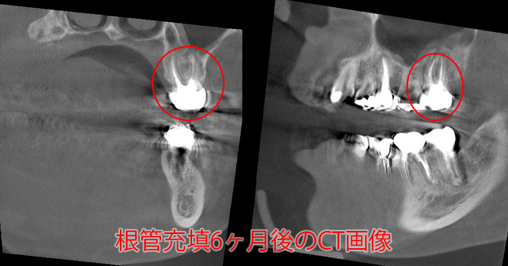 初診時と術後6か月のCT画像の比較